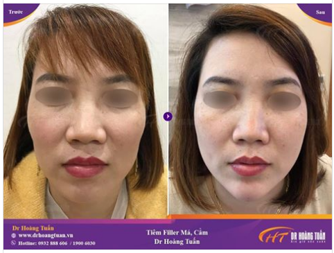 Trước và sau khi tiêm Filler Dr Hoàng Tuấn