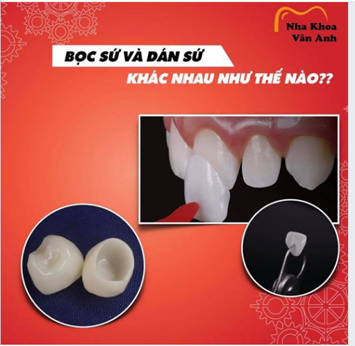 BỌC SỨ VÀ DÁN SỨ KHÁC NHAU NHƯ THẾ NÀO