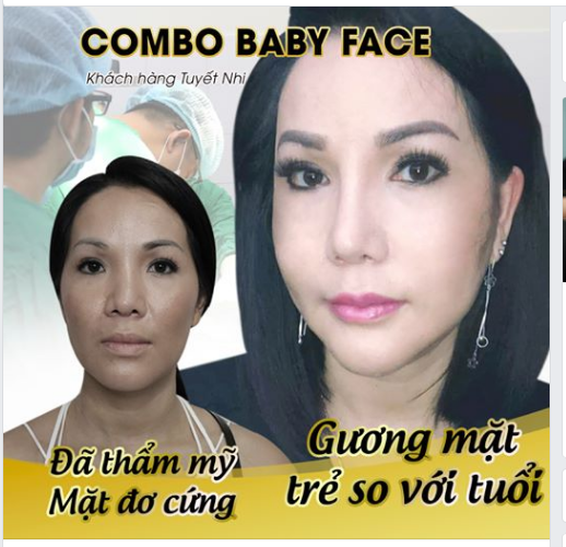 Chị khách đã sở hữu nhan sắc xinh đẹp, trẻ trung khi sử dụng dịch vụ " Combo Baby Face- thay đổi toàn diện tại Dr Trí" 