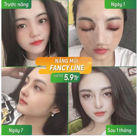 Cùng chiêm ngưỡng quá trình lột xác của chị Phương Oanh chỉ với nâng mũi Fancy Line tại Dr.Hoan
