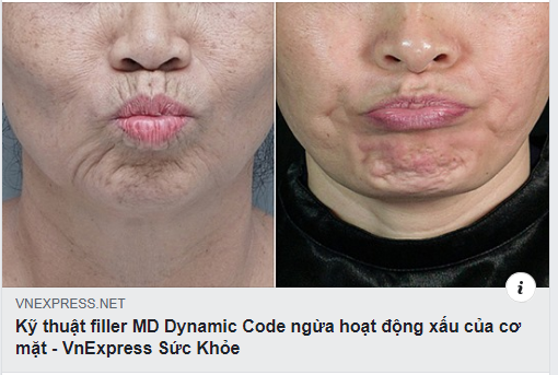  DIVA TRÊN BÁO VNEXPRESS 