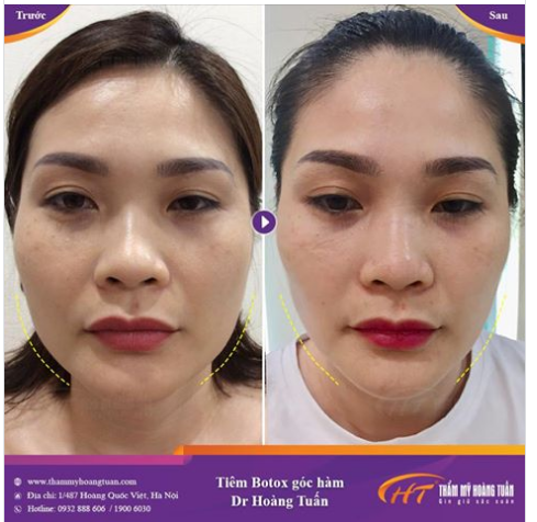 Kết quả thuyết phục tiêm Botox thon gọn góc hàm tạo khuôn mặt ...