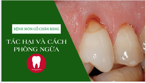 MÒN CỔ CHÂN RĂNG VÀ NHỮNG ĐIỀU CẦN THIẾT