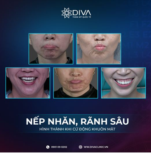 NẾP NHĂN, RÃNH SÂU GÂY CHẢY XỆ GƯƠNG MẶT – LÀM SAO KHẮC PHỤC?