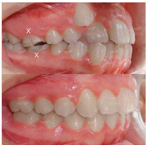 Những ưu điểm của phương pháp niềng răng mắc cài kim loại truyền thống