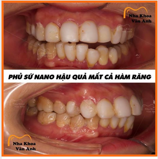 PHỦ SỨ NANO HẬU QUẢ HỎNG CẢ HÀM RĂNG