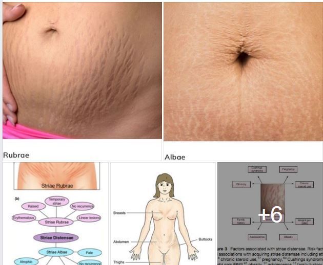RẠN DA (STRETCH MARKS) : NGUYÊN NHÂN VÀ HƯỚNG ĐIỀU TRỊ