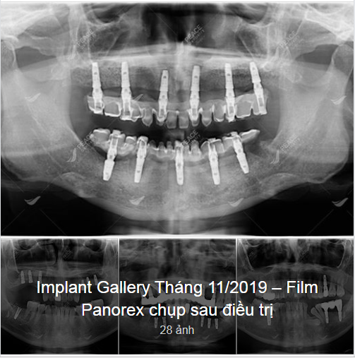 Tổng hợp một số ca cấy ghép Implant hoặc phục hình trên Implant điển hình được thực hiện tại Peace Dentistry TP.HCM trong tháng 11/2019.