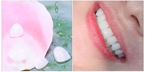 Công nghệ dán sứ Veneer Variolink ES sử dụng mặt sứ siêu mỏng chỉ 0,3 mm hiệu chỉnh răng thưa, thô, xỉn màu, mang đến cho bạn nụ cười tỏa nắng.