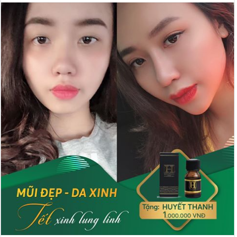 Feedback SAU NÂNG MŨI CỦA CHỊ HOÀNG THANH