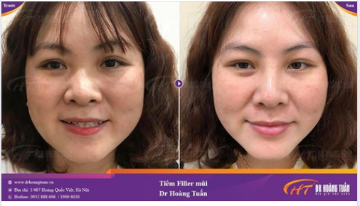 Hình ảnh trước và sau tiêm Filler mũi 01 tuần tại Dr Hoàng Tuấn