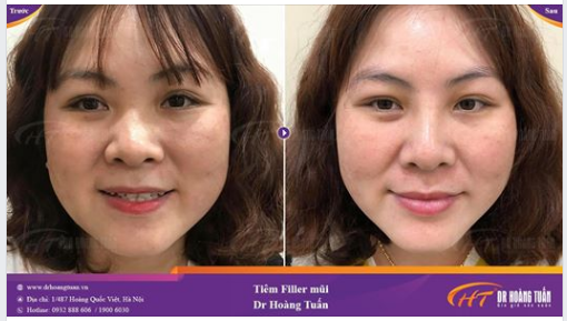 Hình ảnh trước và sau tiêm Filler mũi 01 tuần tại Dr Hoàng Tuấn