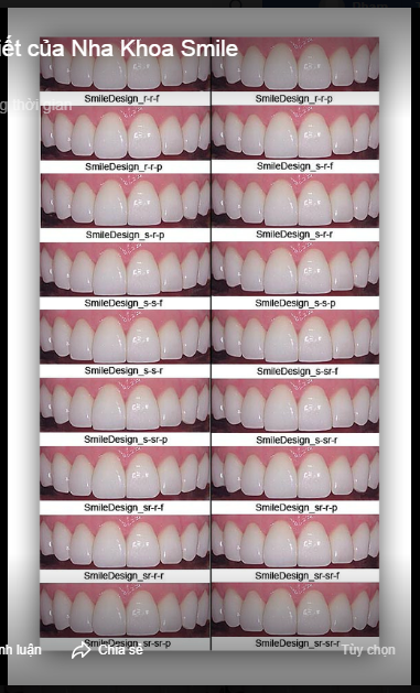  Nhu cầu làm răng thẩm mỹ, cải thiện nụ cười càng tăng cao cũng là thời điểm lượng nhu cầu tìm kiếm những dáng răng sứ đẹp càng nhiều hơn gấp bội.