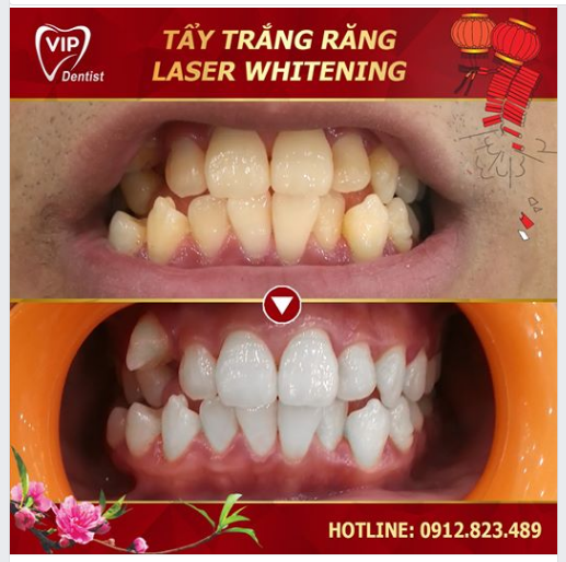 TẾT CẬN KỀ, RĂNG TRẮNG SAY MÊ 