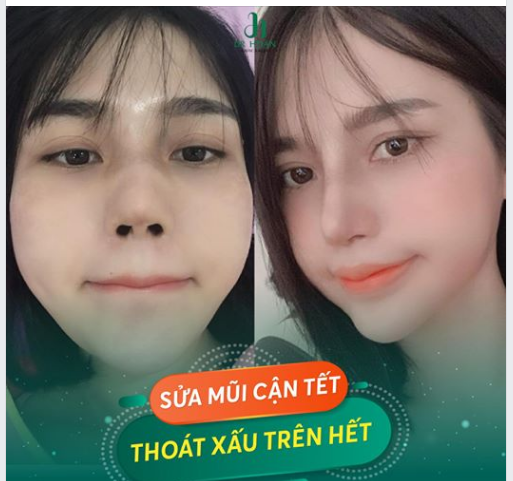 TẾT ĐẾN RỒI SỬA MŨI NGAY THÔI