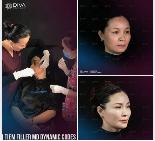 TIÊM FILLER MD DYNAMIC CODES: HÓA QUÝ BÀ SANG CHẢNH, THẦN THÁI CHỈ SAU 1H