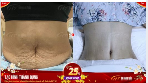 Vì sao chị em nô nức đi tạo hình thành bụng tại Dr Hoàng Tuấn?