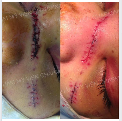  Ai cũng muốn có một khuôn mặt không tì vết, bỗng dưng một ngày xui rủi trên khuôn mặt bạn xuất hiện một vết sẹo xấu xí do tai nạn rách da thì phải làm sao? Mình tham khảo thêm phương án xử lý nhé.