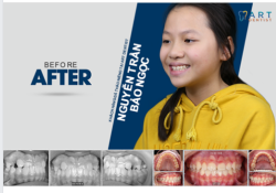 Bạn Nguyễn Trần Bảo Ngọc đến với Art trong tình trạng bị khớp cắn ngược, răng mọc chen chúc, lệch lạc.