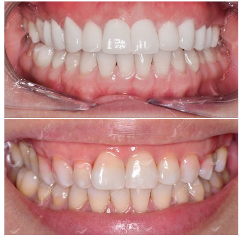 Ca lâm sàng: phẩu thuật cắt nướu kết hợp điều chỉnh xương ổ răng và thẩm mỹ răng sứ