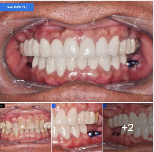 Ca lâm sàng: tháo răng sứ cũ, bọc lại răng sứ toàn hàm, cấy ghép Implant vùng răng 36, 37, 46, 47