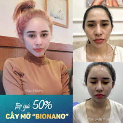 CẤY MỠ TỰ THÂN BIONANO trợ giá tới 50%