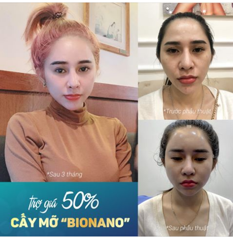 CẤY MỠ TỰ THÂN BIONANO trợ giá tới 50%