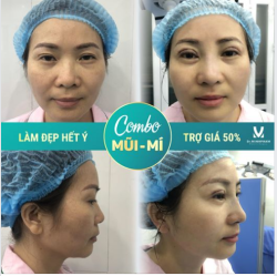 Combo MŨI MÍ – LÀM ĐẸP HẾT Ý