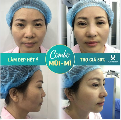 Combo MŨI MÍ – LÀM ĐẸP HẾT Ý