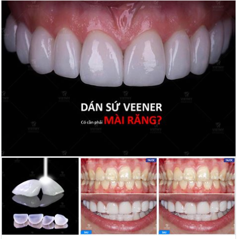 DÁN SỨ VENEER CÓ CẦN MÀI RĂNG HAY KHÔNG