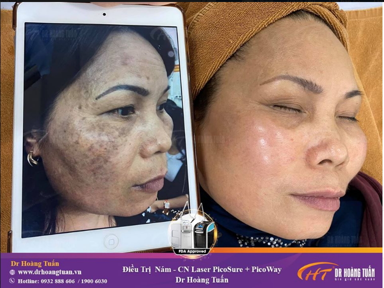 Để chị em hiểu rõ hơn về sự cải thiện của làn da trước và sau khi sử dụng liệu trình trị nám với bộ đôi công nghệ PicoSure tại Dr Hoàng Tuấn.
