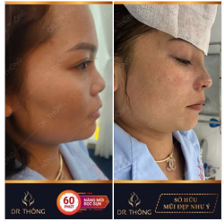  ĐẾN DR.THÔNG MŨI XẤU SẼ HÓA MŨI XINH