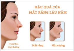 HẬU QUẢ ĐÁNG SỢ KHI BỊ MẤT RĂNG LÂU NGÀY