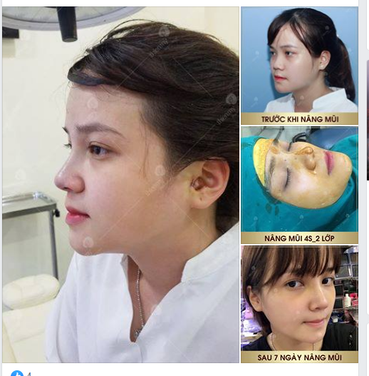 Hình ảnh khách hàng ngay sau khi phẫu thuật nâng mũi bọc sụn 4S 2 LỚP với DÁNG MŨI CHỮ S ĐẸP HOÀN HẢO