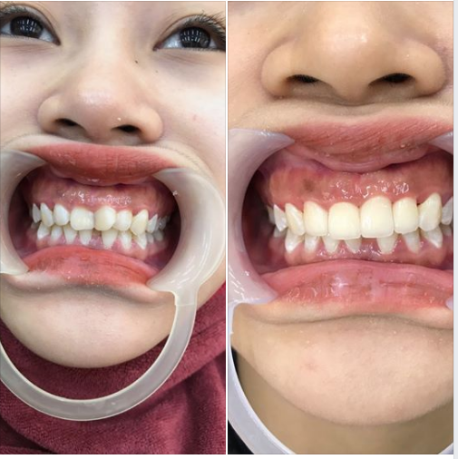 HOÀN THIỆN RĂNG XINH - TỰ TIN LÀ CHÍNH MÌNH ​​​​​​​