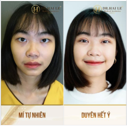 "LÊN HƯƠNG" NHỜ CẮT MÍ THẨM MỸ ĐẸP XUẤT SẮC CÓ " 1 KHÔNG 2"