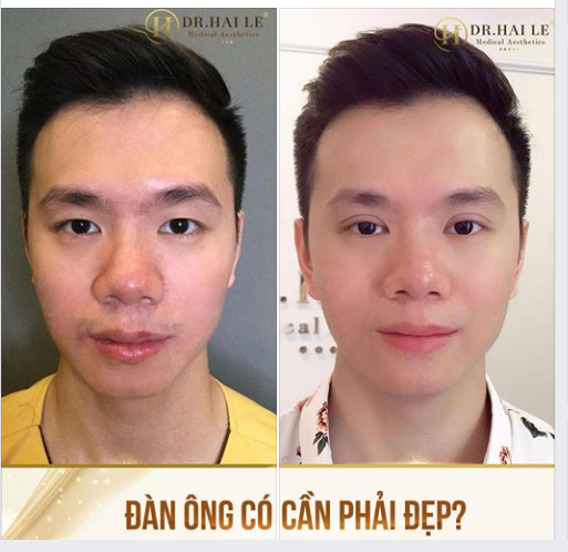  Nếu bạn là nam giới còn đang băn khoăn: NÊN HAY KHÔNG CẮT MẮT 2 MÍ thì đừng bỏ qua bài viết này nhé!