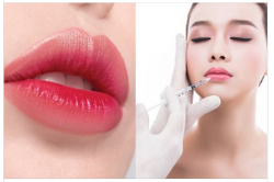 Nhiều chị em đã lựa chọn phương pháp tiêm filler môi.