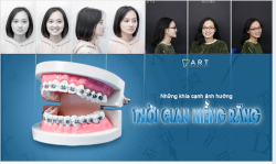 NHỮNG KHÍA CẠNH ẢNH HƯỞNG TỚI THỜI GIAN NIỀNG RĂNG