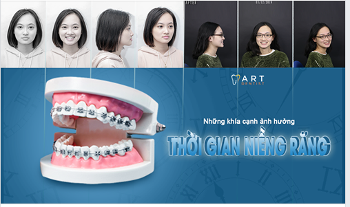 NHỮNG KHÍA CẠNH ẢNH HƯỞNG TỚI THỜI GIAN NIỀNG RĂNG