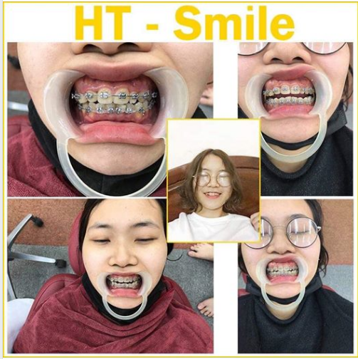 NIỀNG RĂNG THAY ĐỔI NHỮNG GÌ MÀ KHIẾN BẠN ĐẸP HƠN 