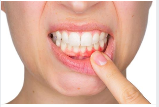  Nướu răng khỏe mạnh là nướu rắn chắc và có màu hồng nhạt. Nếu chúng đột nhiên sưng húp, sẫm màu đỏ và dễ chảy máu thì có thể đó là do bệnh nha chu.