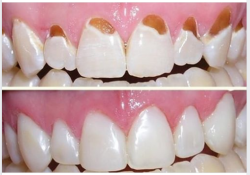 TRÁM RĂNG THẨM MỸ COMPOSITE KHẮC PHỤC MÒN RĂNG HIỆU QUẢ