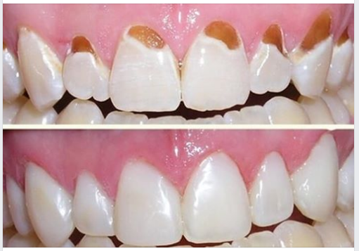 TRÁM RĂNG THẨM MỸ COMPOSITE KHẮC PHỤC MÒN RĂNG HIỆU QUẢ