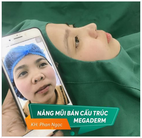 WOW! MŨI ĐẸP XUẤT SẮC CHỈ TRONG TÍCH TẮC