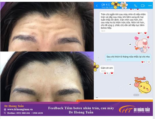  Bạn có tin tiêm Botox xóa nhăn trán sẽ sở hữu "Trán Cao" hơn không?