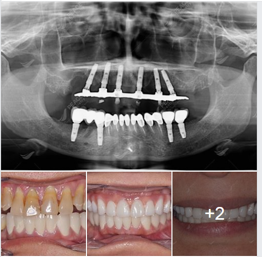 Ca lâm sàng: All on 6 Implant cho hàm trên, cấy 4 trụ Implant cho hàm dưới, kết hợp thẩm mỹ răng sứ