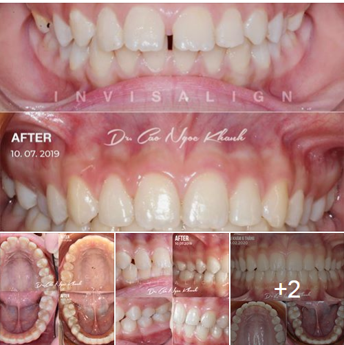 Ca lâm sáng chỉnh nha Invisalign hở kẽ 2 hàm, cắn sâu (thời gian: 8 tháng)