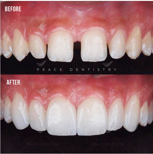 Ca lâm sàng: Đóng kẻ răng thưa với mặt sứ Veneer Emax Press CAD/CAM (Xử lý bề mặt men răng)