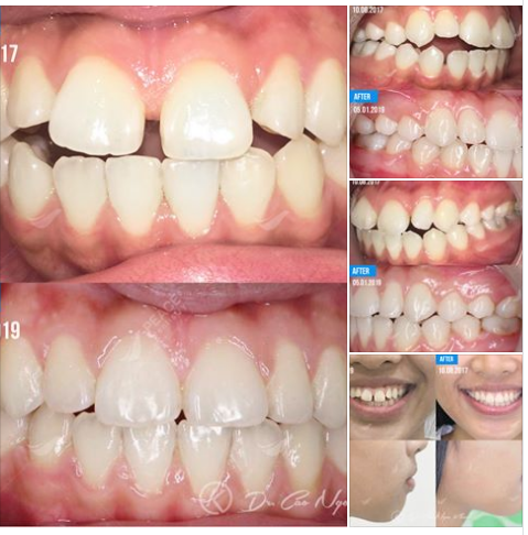  Ca lâm sàng: Niềng răng mắc cài kim loại, không nhổ răng và hoàn thành trong 15 tháng